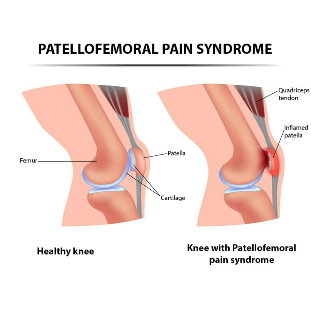 Managing Patellofemoral Pain Syndrome